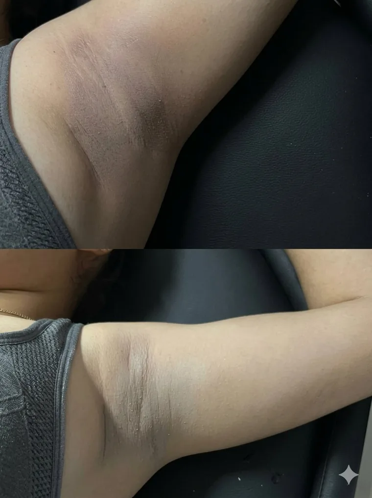 Antes y después de blanqueamiento corporal en clienta de Venus Beauty Clinic, Hermosillo
