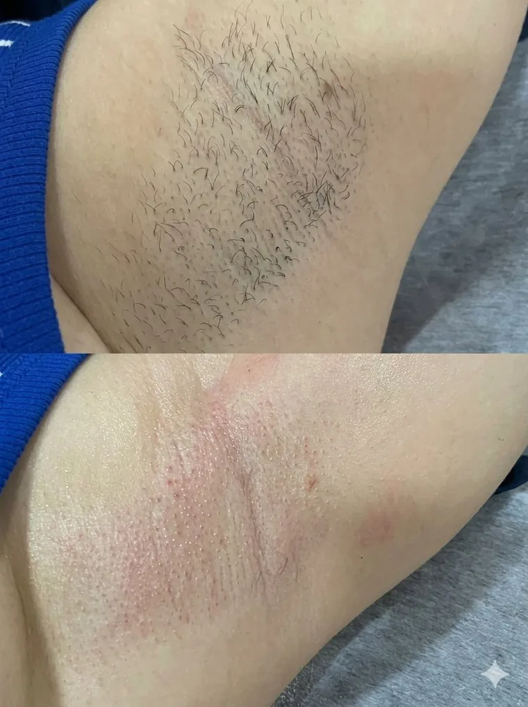 Antes y después de depilación con cera en clienta de Venus Beauty Clinic, Hermosillo
