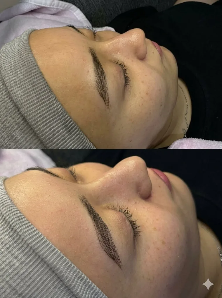 Antes y después de HydraFacial en clienta de Venus Beauty Clinic, Hermosillo
