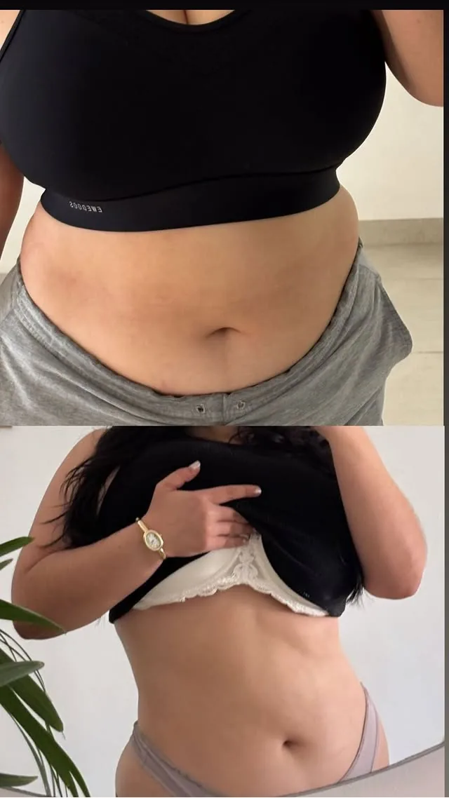 Antes y después de masaje reductivo en clienta de Venus Beauty Clinic, Hermosillo